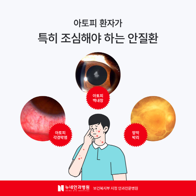 안질환 원인이 아토피 피부염? 눈 자주 비빈다면 안과검진 필요