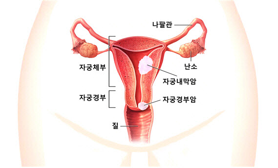 자궁경부암은 줄고, 자궁내막암은 증가세...대처방법은?