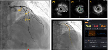 인공지능, 심혈관 스텐트 시술 정확도 높인다