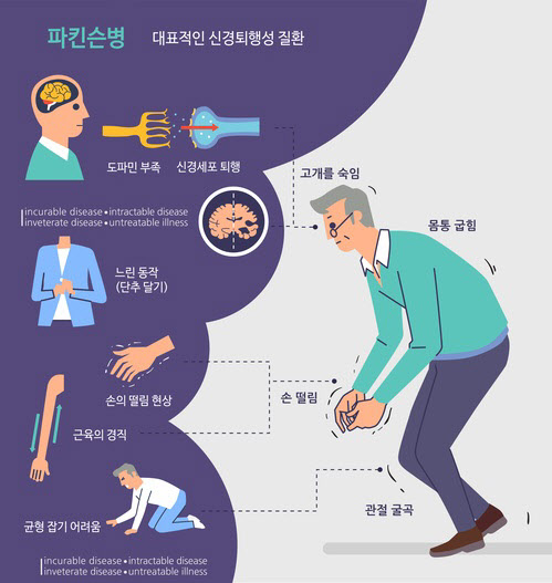 노령층 손 떨고 행동 느려지면 파킨슨병 의심… 방치하면 치료 어려워