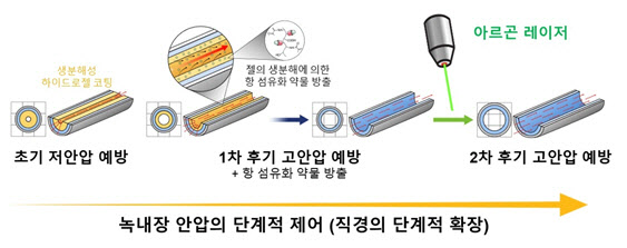 녹내장 진행에 맞춰 안압 조절 가능한 치료 튜브 개발