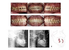 비발치 교정의 진화, ‘주걱턱’ 최대 3배 치아이동 공간 확보 규명