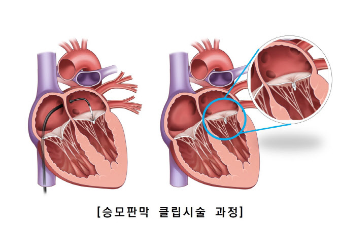 서울아산병원, 승모판막 클립시술 국내 첫 100례