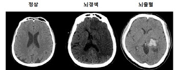 뇌 CT·MRI 무슨 차이일까