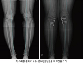 [굿클리닉]관절염 원인 O자형 휜다리...'교정술+줄기세포술'로 연골재생효과 입증