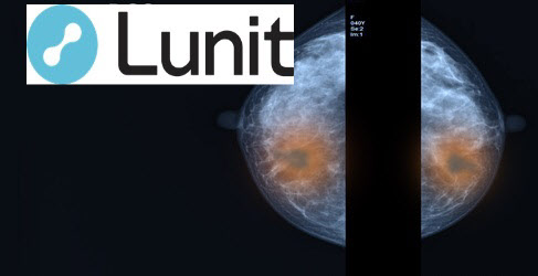 유방암 치료후 부작용 예측 AI 등장...‘루닛’도 뛰어들까