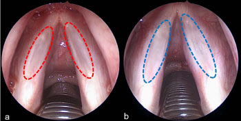 난치성 음성질환 ‘성대구증’에 레이저 성대성형술 치료 효과 입증