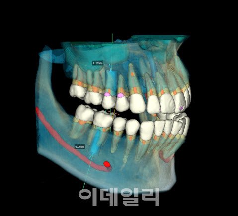 바텍, 치과 진단 솔루션에 AI 접목…“기술 개발 중”