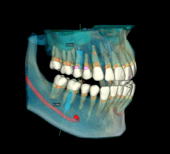 바텍, 치과 진단 솔루션에 AI 접목…“기술 개발 중”