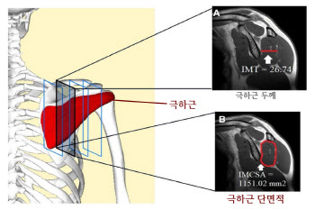 국제성모병원 김영욱 교수, 견갑상신경 포착증후군 진단 기준 제시