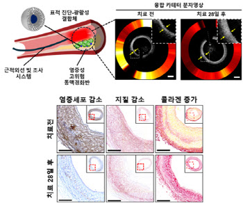 빛을 이용한 심장 혈관내 치료 기술 개발