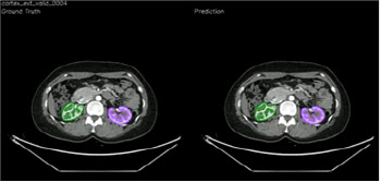 AI 활용한 신장 피질 부피 측정으로 기증 후 신기능 손실 예측