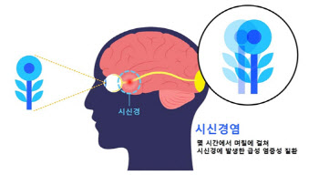 서울대병원, 유형별 시신경염 예후인자 규명