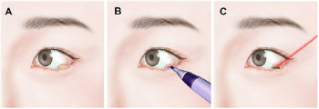 레이저를 이용한 눈꺼풀 양성종양 제거술 개발