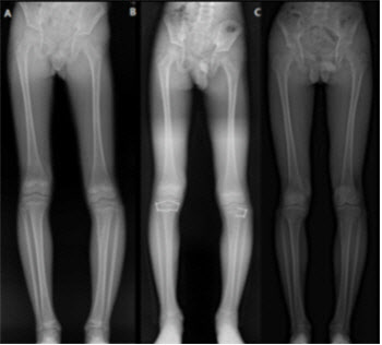 ‘단발성 골연골종’ 환자에서 다리 변형 발생 위험인자 밝혀