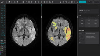 제이엘케이, 뇌졸중 AI 솔루션 美 FDA 승인