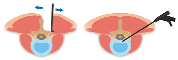 디스크·협착증 척추 수술도 내시경으로 안전하게