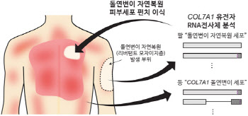 새로운 희귀 중증 유전성 피부질환 치료법 보고