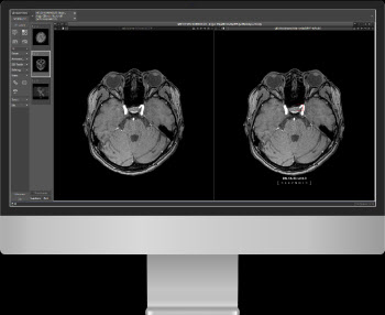 딥노이드, 업계 최초 뇌동맥류 AI 진단 솔루션 보험 등재