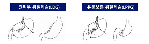 복강경 유문보존 위절제술, 조기 위암 치료 효과 및 안전성 규명