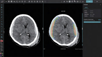제이엘케이, 美 FDA 뇌졸증 AI 솔루션 JLK-ICH 허가 획득 "연 8600만건 시장성 주목"