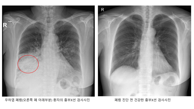 폐렴구균 백신 접종을 통해 사전에 폐렴을 예방하는