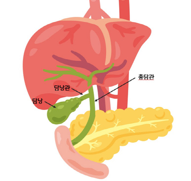 기름진 음식만 먹으면 명치에 통증 생긴다면 담관결석 의심해야