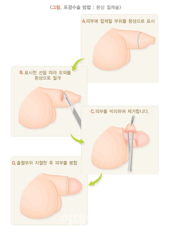 포경수술, 필요한가요?[안치영의 메디컬와치]