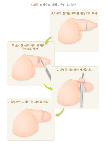 포경수술, 필요한가요?