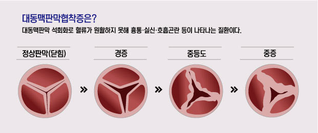 고령층 흉통. 호흡곤란 있다면... ‘대동맥판막협착증’ 위험신호