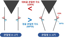 서울대병원, AI로 무릎 정렬에 따른 관절염 위험 차이 규명