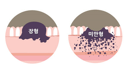 암검진 사각지대 ‘젊은 미만형 위암’ 펩시노겐2 검사로 조기진단 가능