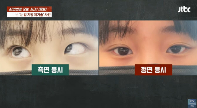 “눈 지방제거 수술 후 ‘사시’ 됐다”…성형외과서 무슨 일이