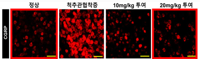"퇴행성 척추질환 치료법에 '태반 추출물 약침' 효과"