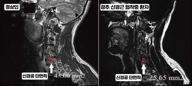 가톨릭관동대 국제성모병원, 경추 신경근협착증 진단 기준 제시
