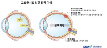 고도근시, 망막 건강의 위험 신호