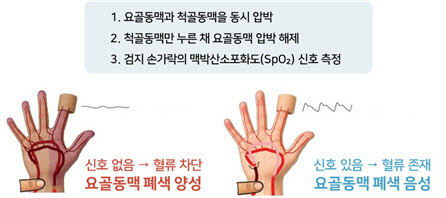 서울대병원, 영유아 수술 후 요골동맥 폐색 예방법 규명