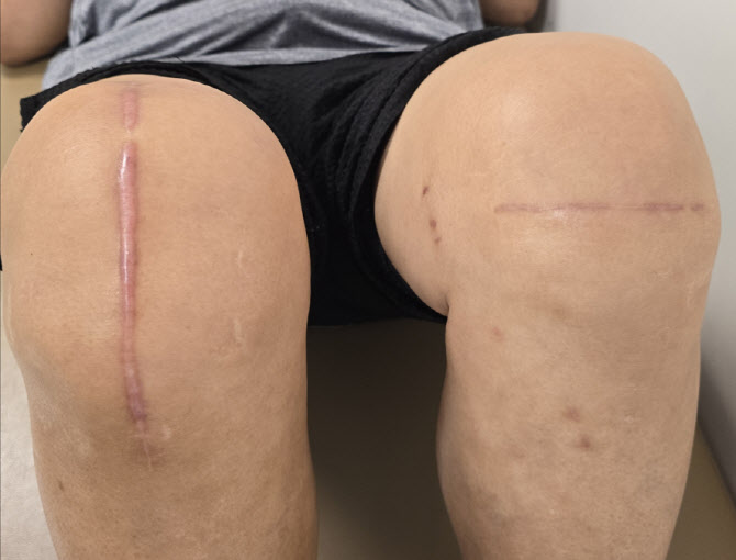 부민병원, 가로절개 로봇인공관절 수술로 새로운 수술 방향 제시