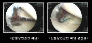 "겨울철 스키·보드 즐기다 무릎 '뚝'… 반월상연골판 파열 주의"