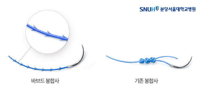 매듭 필요 없는 봉합실, 절개탈장 예방 효과 확인