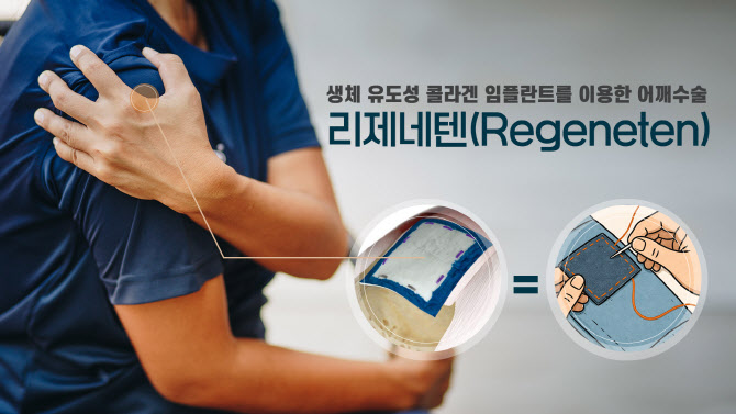 어깨 수술, 리제네텐. 동종이식물 패치로 재파열률 낮춰