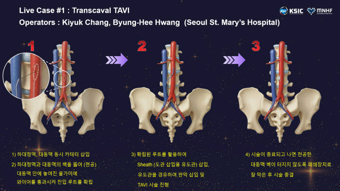 서울성모병원, 국내 첫 경대정맥 대동맥 판막 치환술 실시