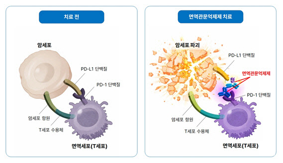 위암 면역항암제도 남녀 효과 달라...‘성차 면역학’ 고려한 치료 전략 필요