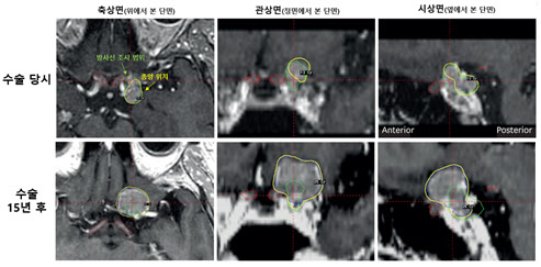부작용 피하려 방사선 줄인 시신경 인접 뇌수막종, 10년 뒤 오히려 시력 저하 위험 높여
