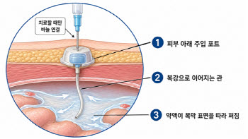 복막전이 4기 위암, 항암제 직접 투여로 수술 가능성 높였다