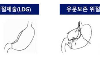 복강경 유문보존 위절제술, 조기 위암 치료 효과 및 안전성 규명