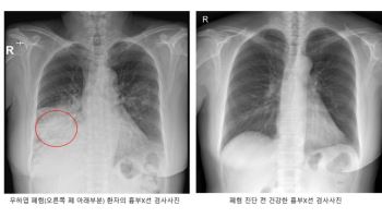 폐렴구균 백신 접종을 통해 사전에 폐렴을 예방하는