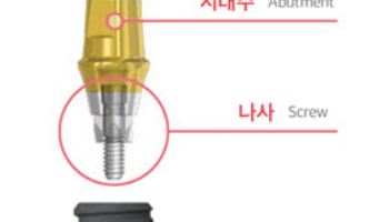 잘 씹히는 튼튼한 ‘임플란트’ 위한 5가지 조건