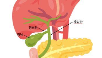 기름진 음식만 먹으면 명치에 통증 생긴다면 담관결석 의심해야