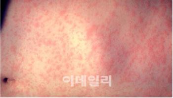 세계 홍역 대유행…여행 후 발열 홍역 의심해야